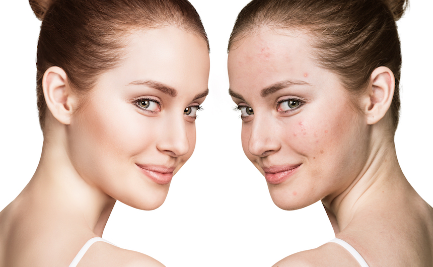 blu-u treatment acne AKs